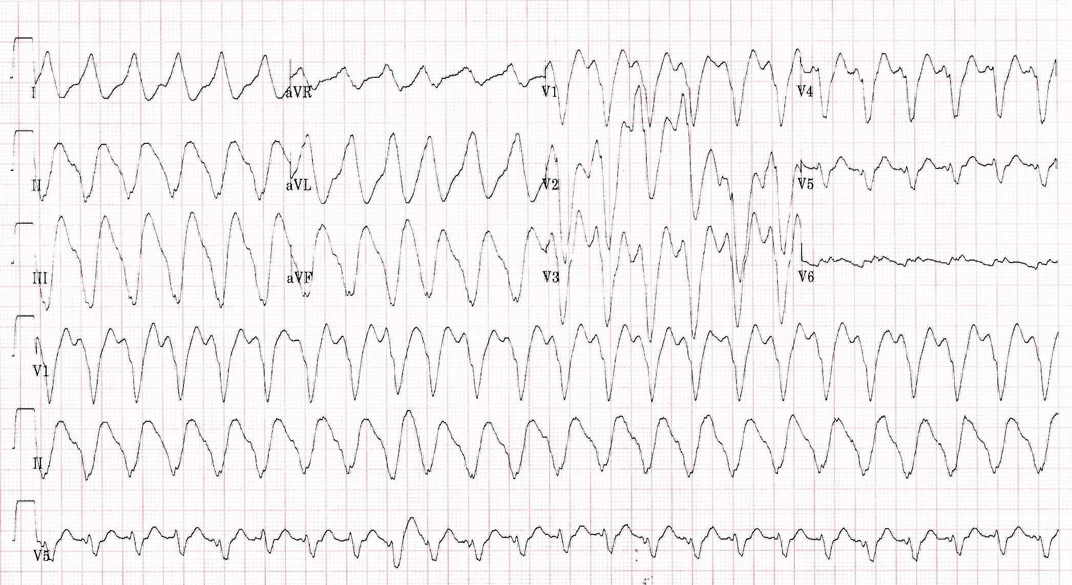 palpitations-chest-pain-emresource